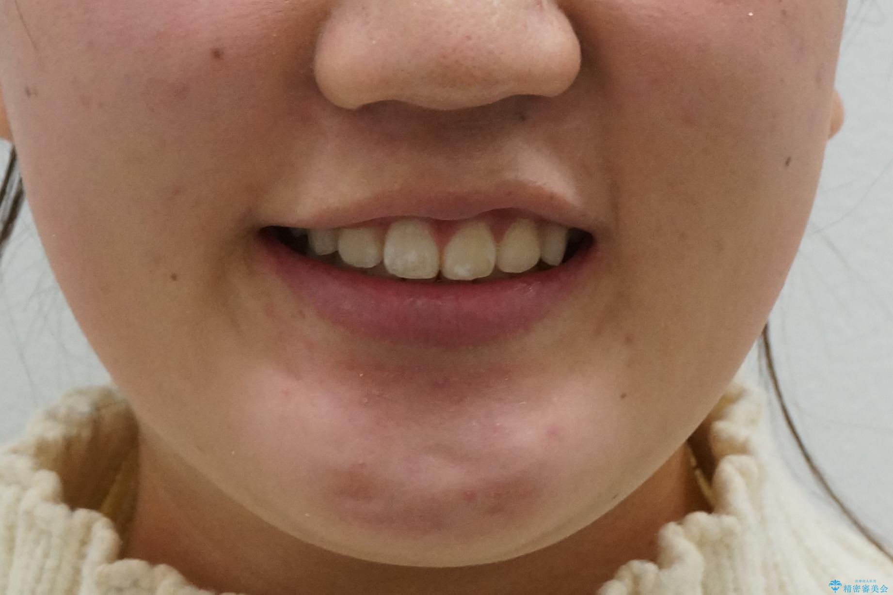 成人式に間に合う 前歯の矯正の治療後(顔貌)