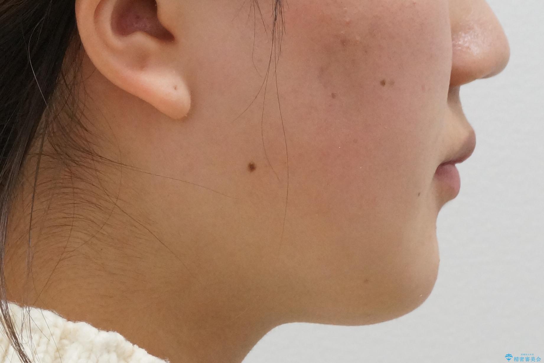 成人式に間に合う 前歯の矯正の治療後(顔貌)