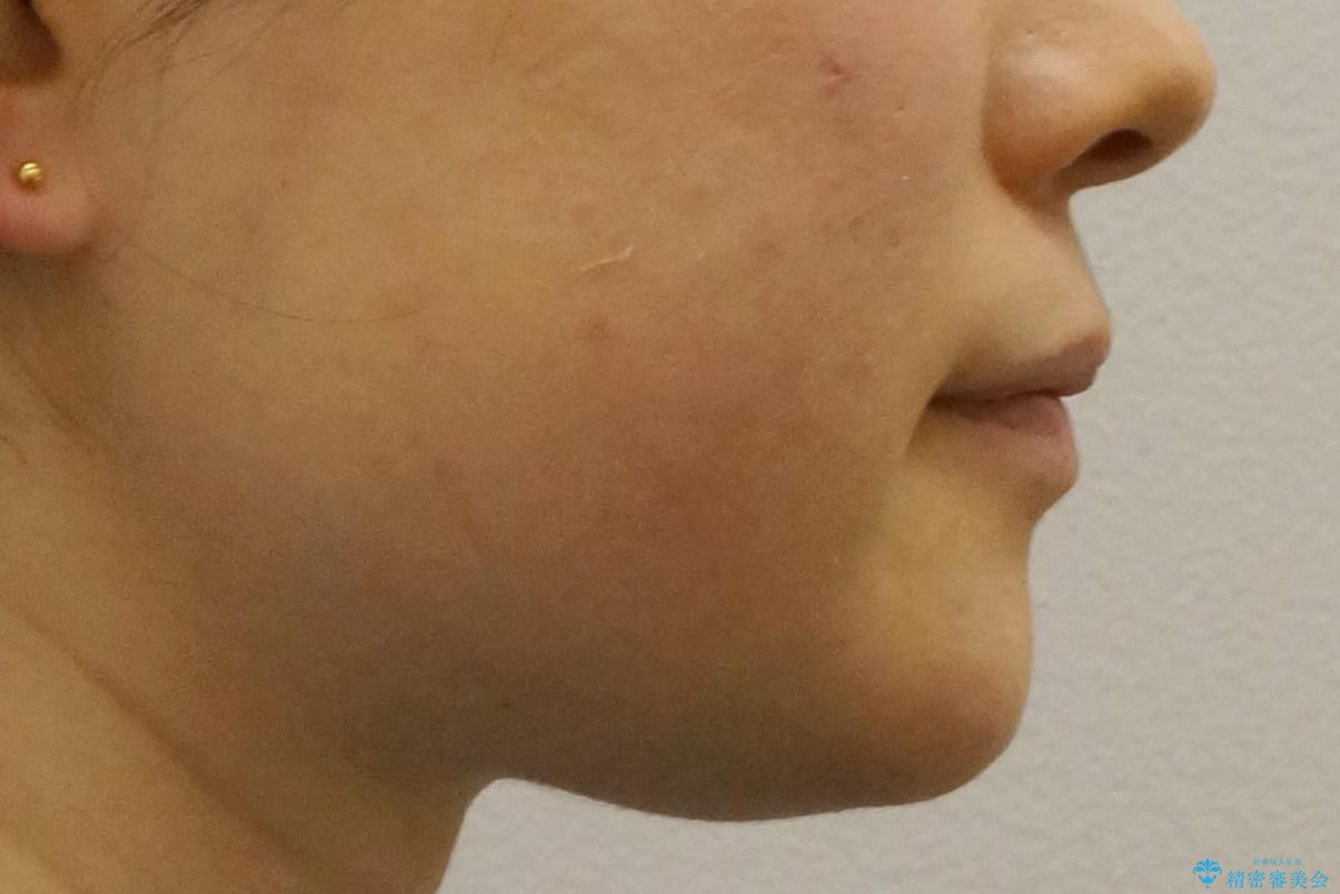 抜かない矯正 前歯がとび出ているのをマウスピースでの治療後(顔貌)