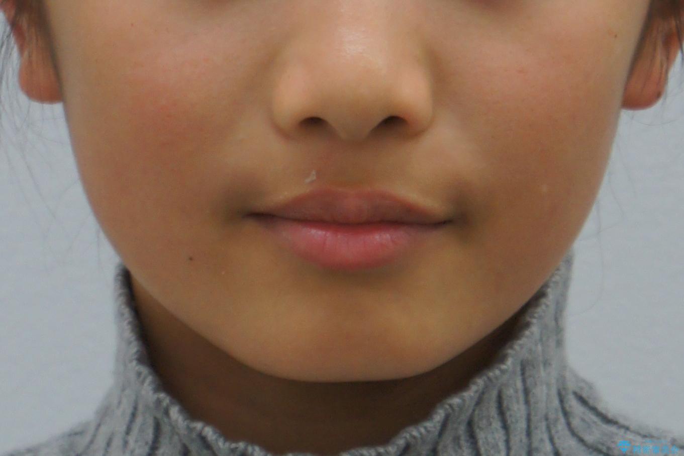 埋まっている犬歯を抜歯して、歯列矯正の治療前(顔貌)