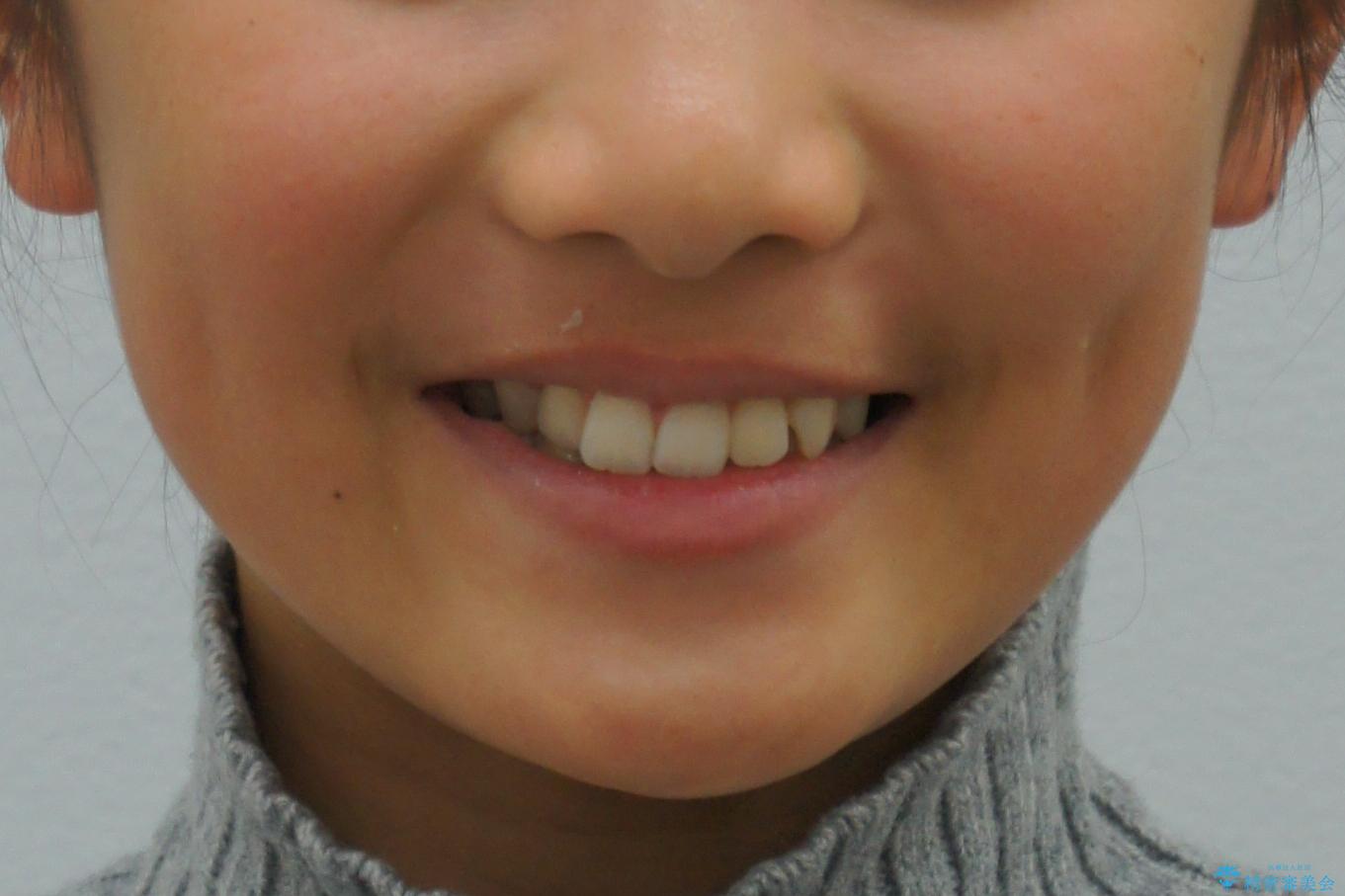 埋まっている犬歯を抜歯して、歯列矯正の治療前（顔貌）
