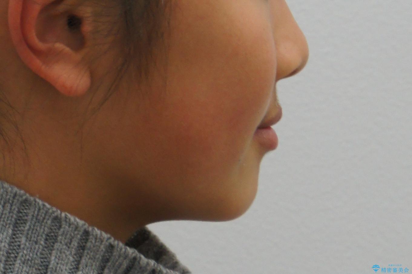 埋まっている犬歯を抜歯して、歯列矯正の治療前(顔貌)