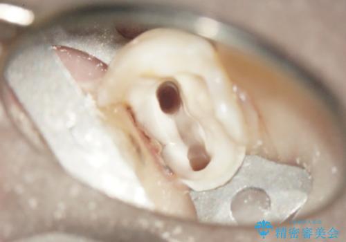 大きな虫歯で崩壊した歯の修復の治療中