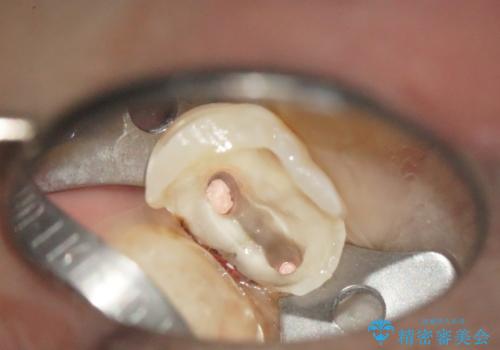 大きな虫歯で崩壊した歯の修復の治療中