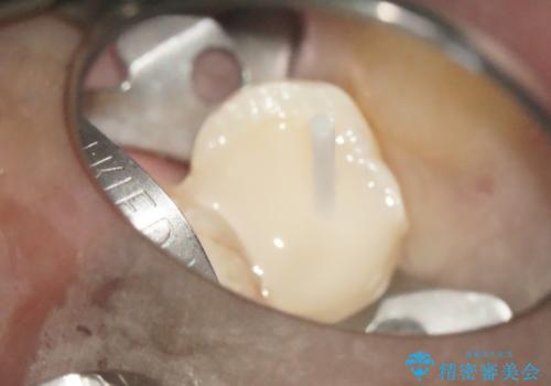 大きな虫歯で崩壊した歯の修復の治療中