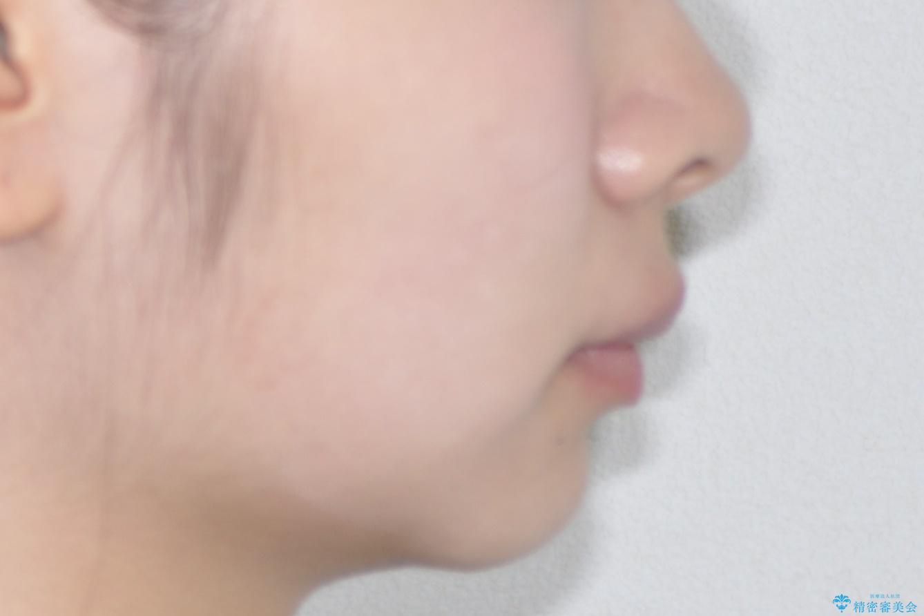 出っ歯の矯正治療 歯を抜かずにインビザラインでの治療前(顔貌)