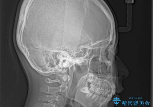 デコボコと深い咬み合わせの改善 インビザラインによる矯正治療の治療前