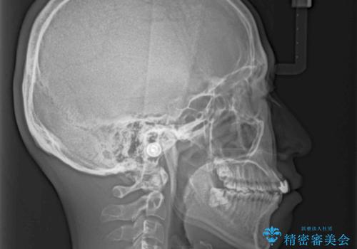 前歯の歯並びとクラウンを改善 インビザラインとオールセラミックの治療前