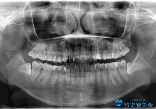 ハーフリンガル矯正　抜歯をして前歯を下げるの治療前