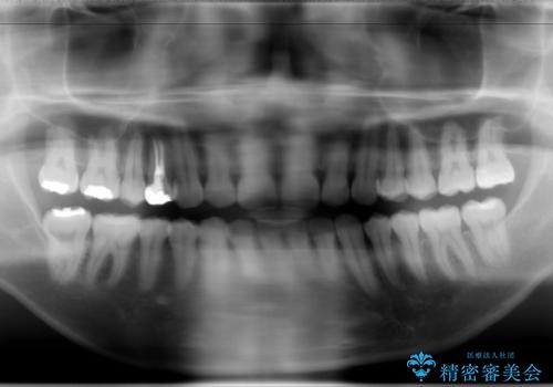 フルリンガル矯正 非抜歯でガタつきを整えるの治療後