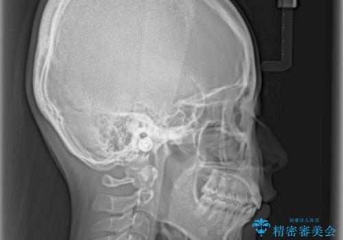 デコボコと深い咬み合わせの改善 インビザラインによる矯正治療の治療後