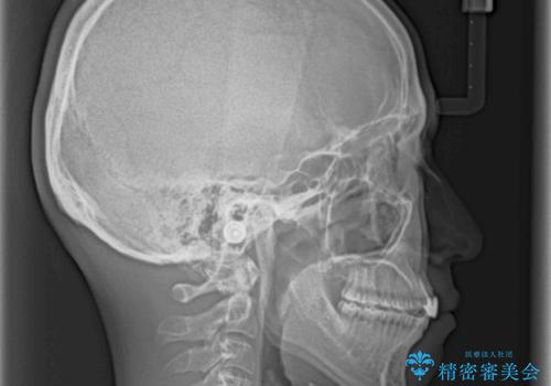 前歯の歯並びとクラウンを改善 インビザラインとオールセラミックの治療後