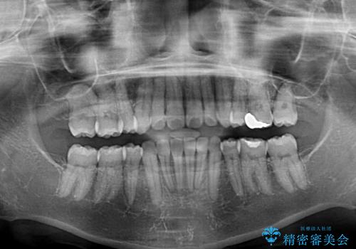軽度な歯列不正 インビザライン・ライトによる矯正治療の治療後