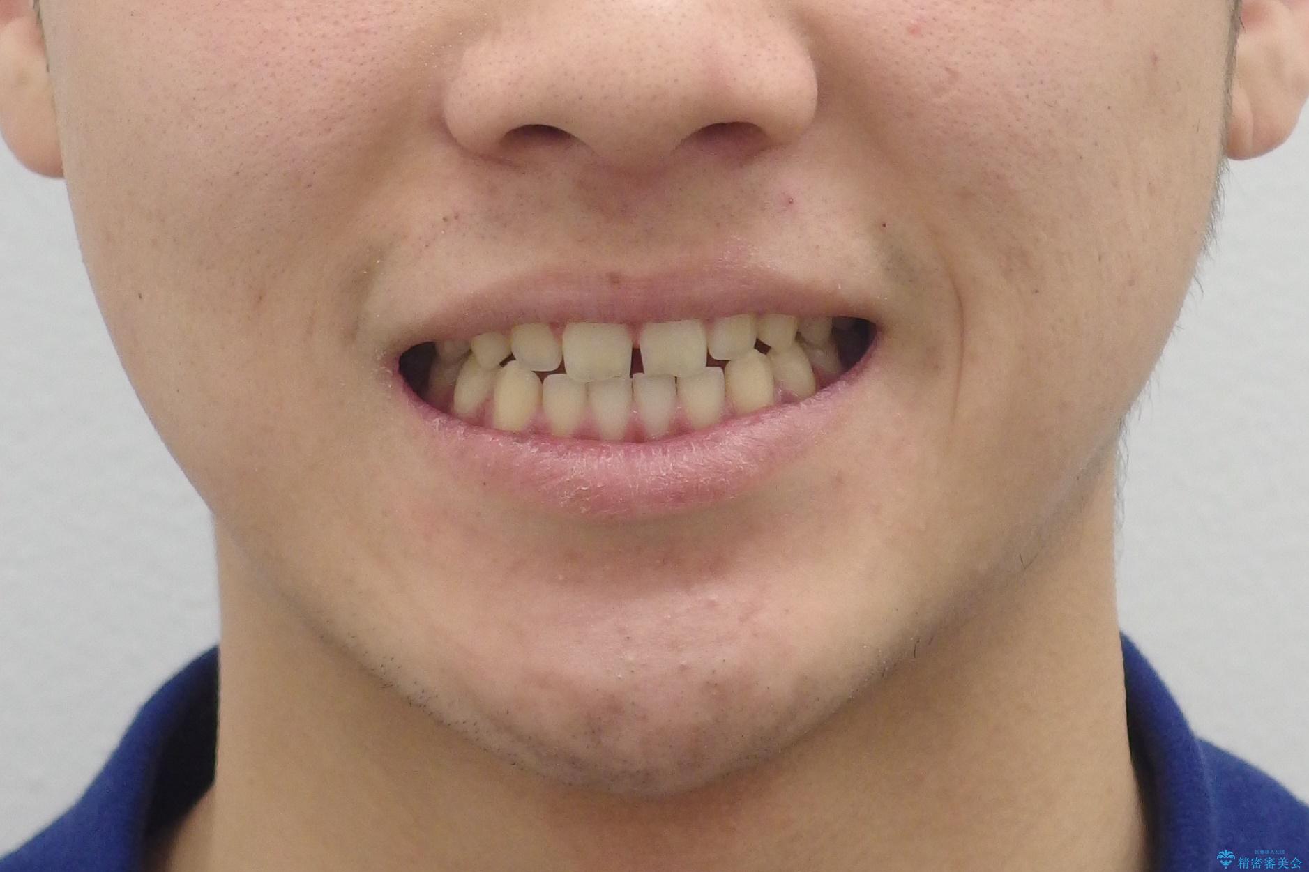 前歯のすきま　受け口　インビザラインでの治療前（顔貌）