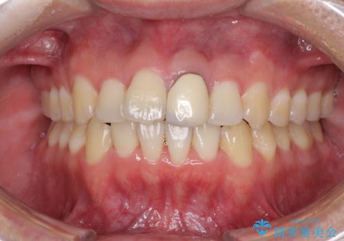 前歯の歯並びとクラウンを改善　インビザラインとオールセラミックの治療中