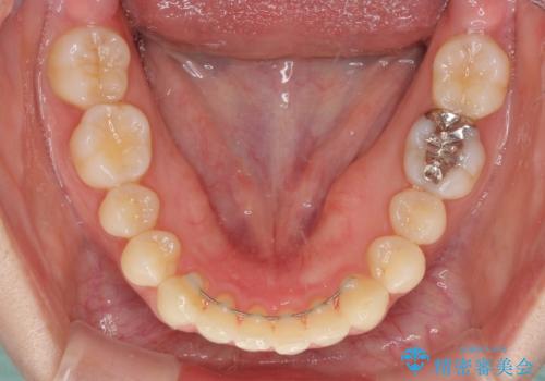 インビザラインによるディープバイトの改善の治療後