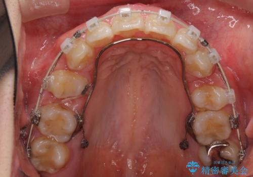 前歯がでていて口が閉じずらい　ワイヤーによる抜歯矯正の治療中