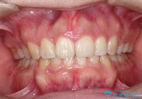 前歯がでていて口が閉じずらい　ワイヤーによる抜歯矯正の治療後