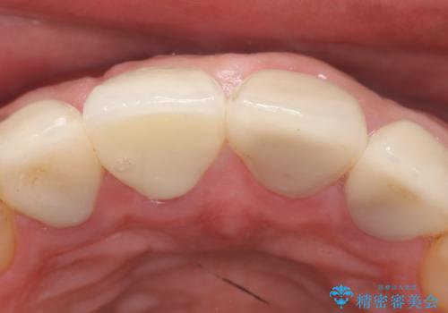オールセラミッククラウン 土台ごと外れた前歯の補綴の治療後