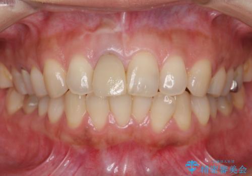 差し歯をもっと自然に 30代女性の治療前