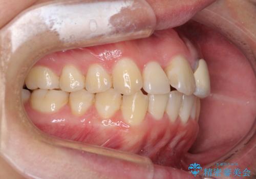 前歯の歯並びとクラウンを改善 インビザラインとオールセラミックの治療中