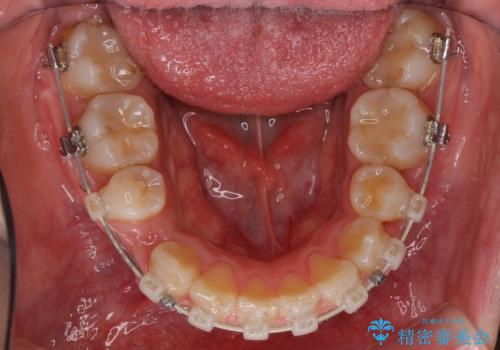 前歯がでていて口が閉じずらい ワイヤーによる抜歯矯正の治療中