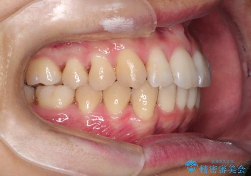 前歯の凸凹をきれいにしたい。インビザラインによる治療の治療後