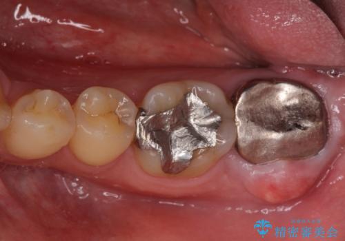 割れてしまった奥歯 インプラントによる咬合回復の症例 治療前