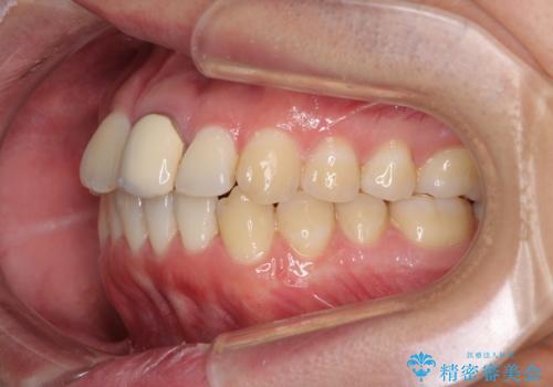 前歯の歯並びとクラウンを改善 インビザラインとオールセラミックの治療中