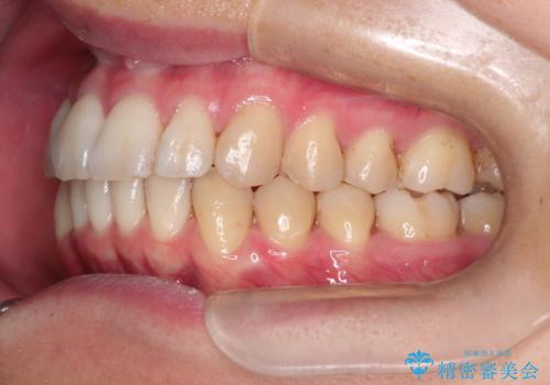 前歯の凸凹をきれいにしたい。インビザラインによる治療の治療後
