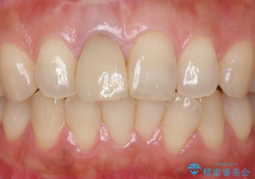 差し歯をもっと自然に 30代女性の治療前