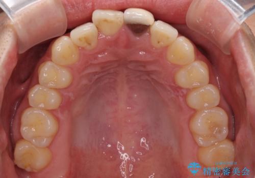 前歯の歯並びとクラウンを改善　インビザラインとオールセラミックの治療中