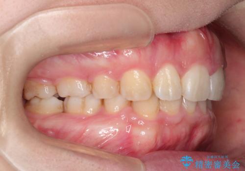 前歯がでていて口が閉じずらい　ワイヤーによる抜歯矯正の症例 治療後