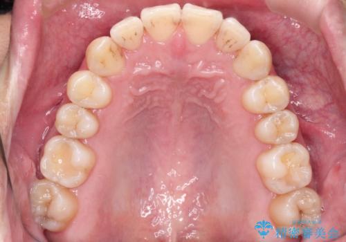 前歯の凸凹をきれいにしたい。インビザラインによる治療の治療後