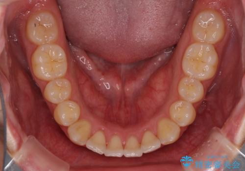 前歯の歯並びとクラウンを改善 インビザラインとオールセラミックの治療中