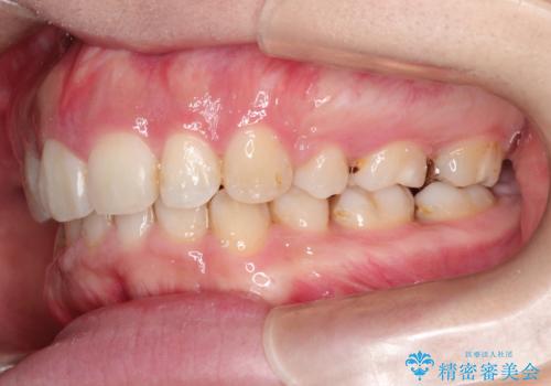 前歯がでていて口が閉じずらい ワイヤーによる抜歯矯正の治療後