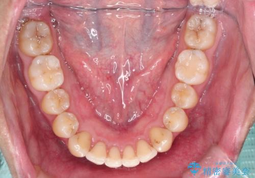 前歯の凸凹をきれいにしたい。インビザラインによる治療の治療後