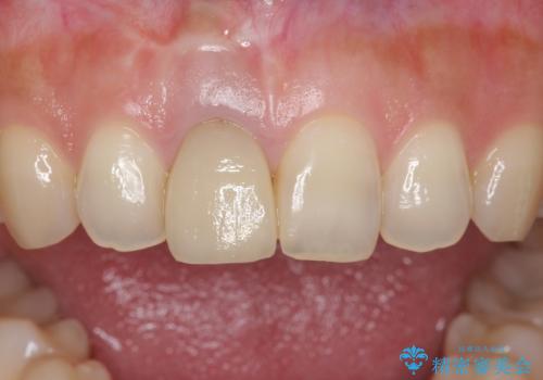 差し歯をもっと自然に 30代女性の治療前
