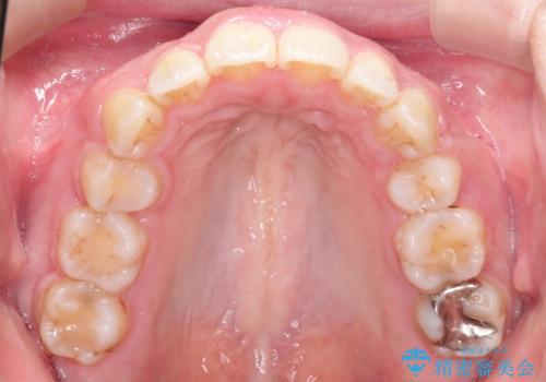 前歯がでていて口が閉じずらい ワイヤーによる抜歯矯正の治療後