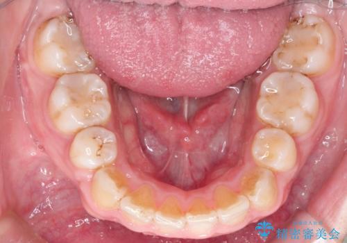 前歯がでていて口が閉じずらい ワイヤーによる抜歯矯正の治療後