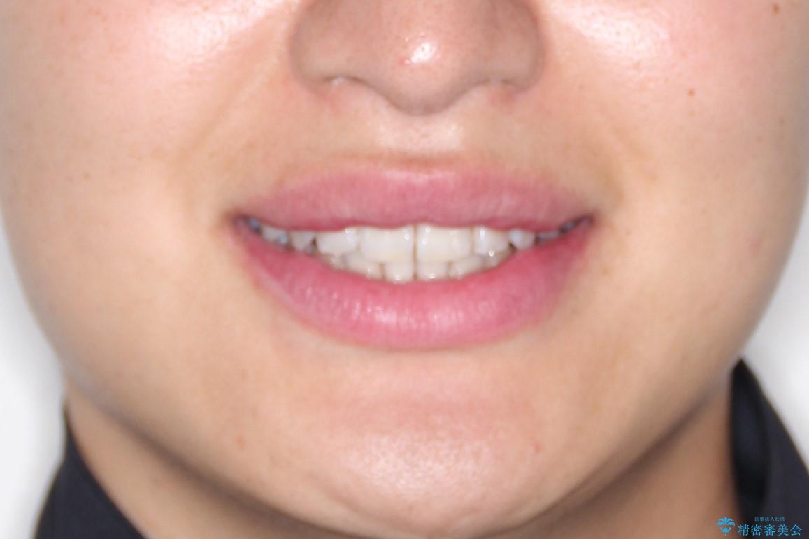 前歯の凸凹をきれいにしたい。インビザラインによる治療の治療後(顔貌)