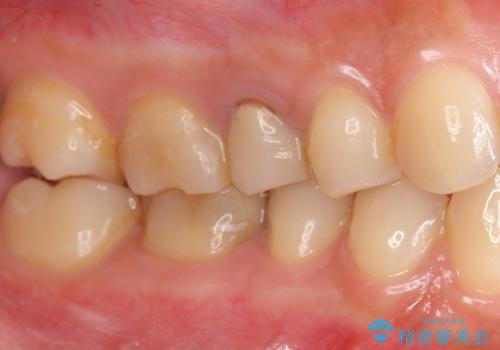 差し歯をもっと自然に 30代女性の治療前