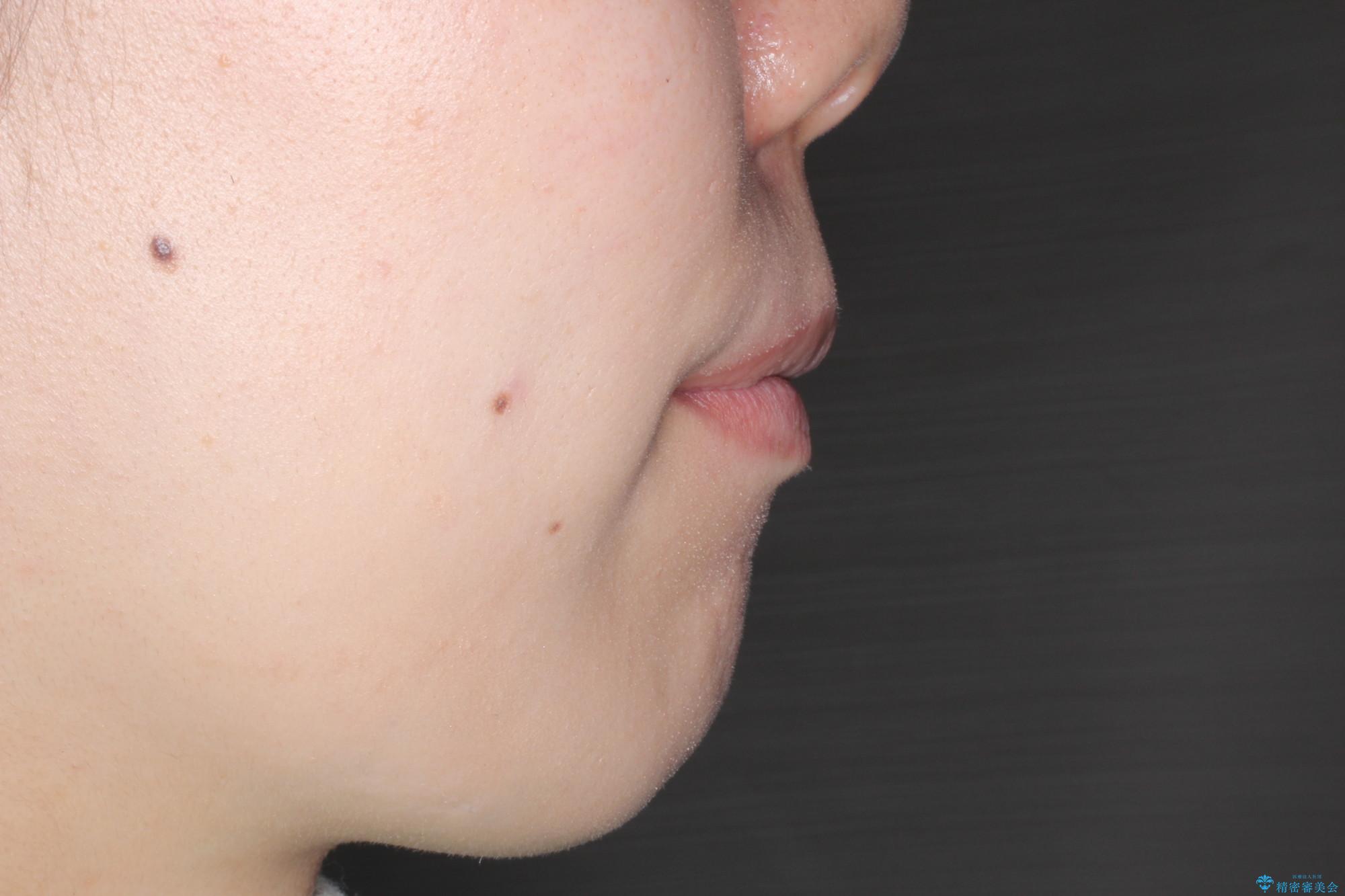 前歯がでていて口が閉じずらい ワイヤーによる抜歯矯正の治療後(顔貌)