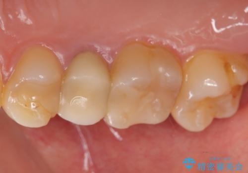 差し歯をもっと自然に 30代女性の治療前