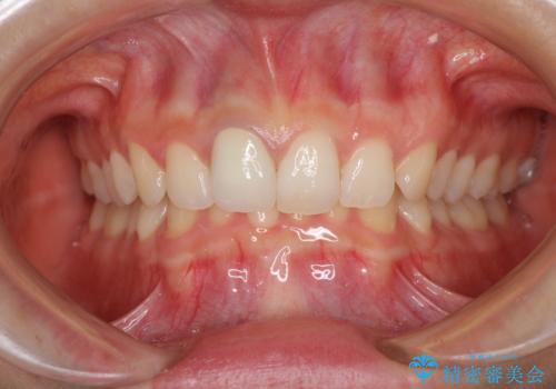 ぶつけて変色した前歯 オーダーメイドタイプのオールセラミッククラウンの治療後