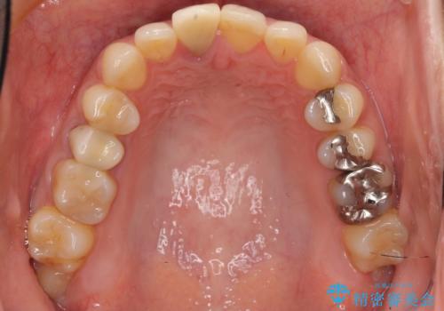 差し歯をもっと自然に 30代女性の治療前