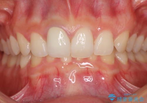 ぶつけて変色した前歯 オーダーメイドタイプのオールセラミッククラウンの治療後