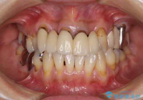 空気が抜けて話しにくい前歯のブリッジの作り直し オールセラミックブリッジにて審美的に仕上げるの治療前