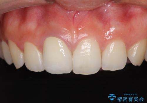 ぶつけて変色した前歯 オーダーメイドタイプのオールセラミッククラウンの治療後