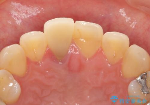 差し歯をもっと自然に 30代女性の治療前